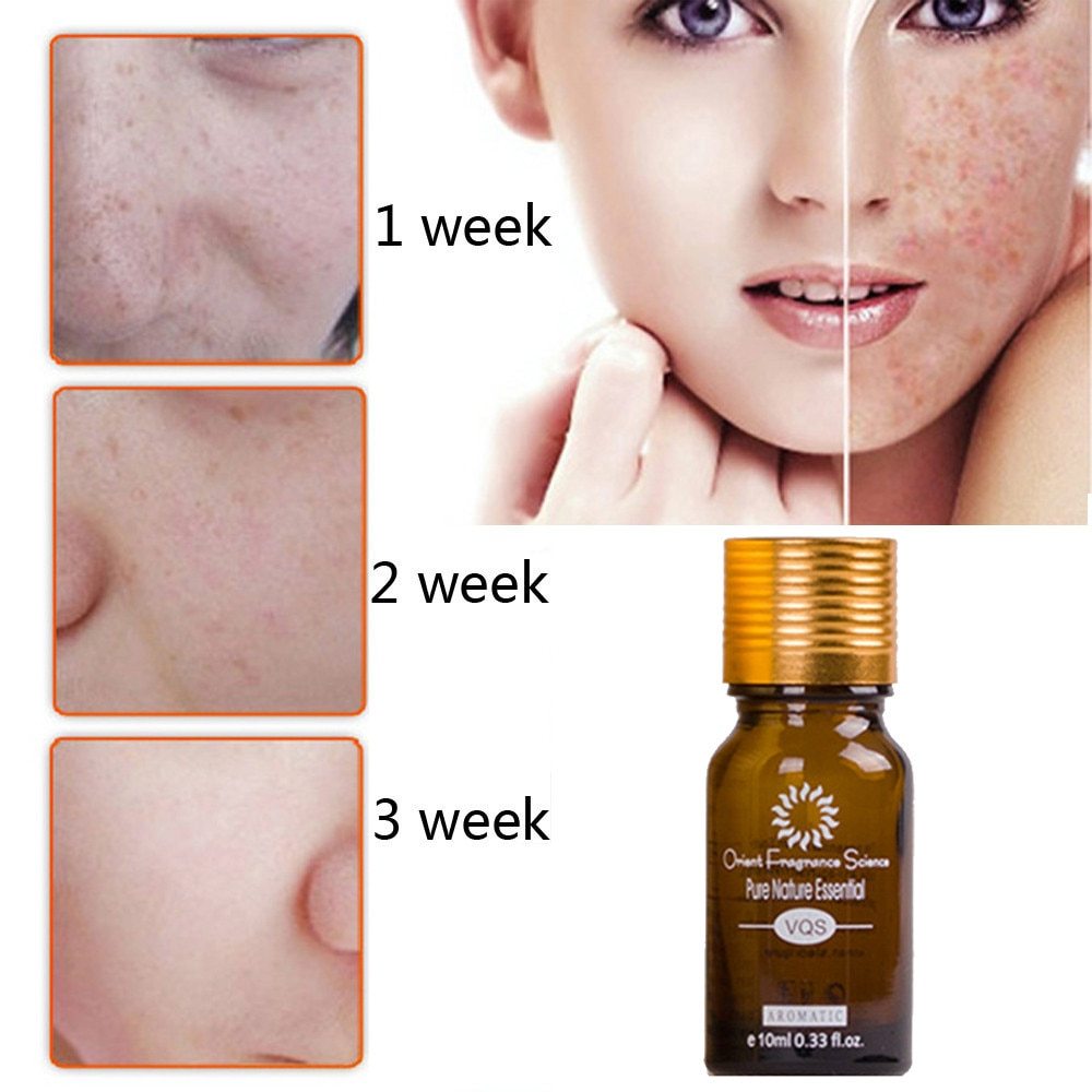 Acne Stretch Marks Scar Removal Essence oil